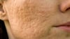 retinol-fight-against-wrinkles-acne