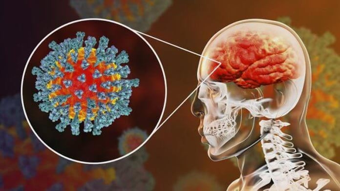 Doctors say coronavirus may cause strokes in young patients with no known risk for stroke
