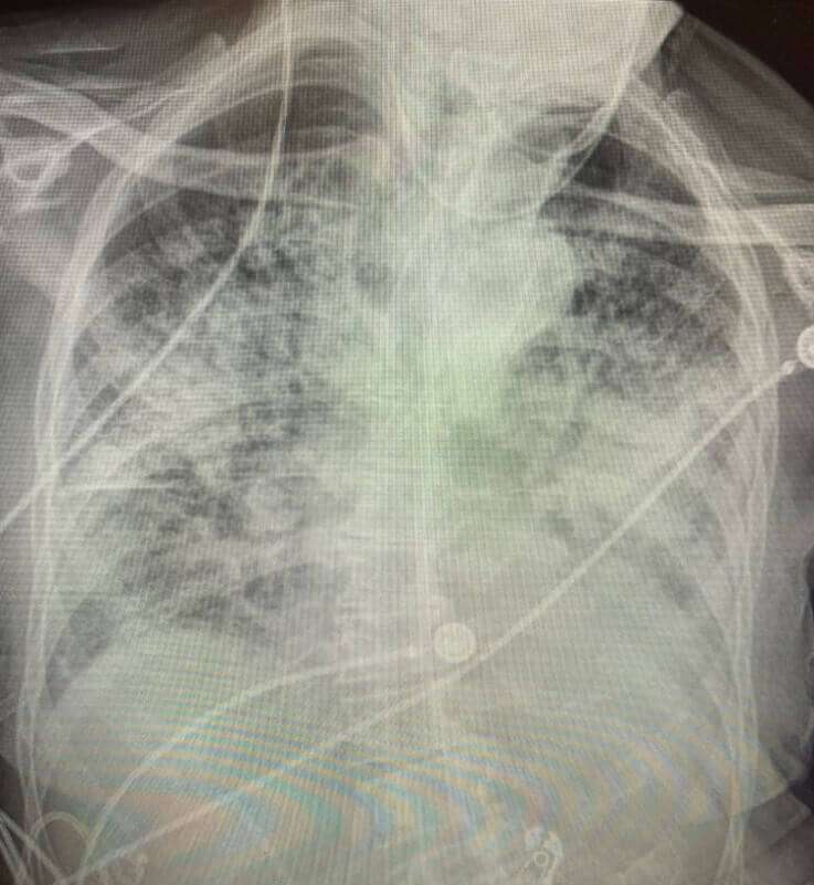 The lungs look almost completely white after Coronavirus recovery