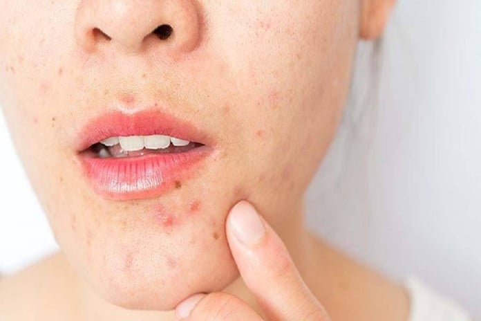 Take care of acne prone skin like this, you also know how...
