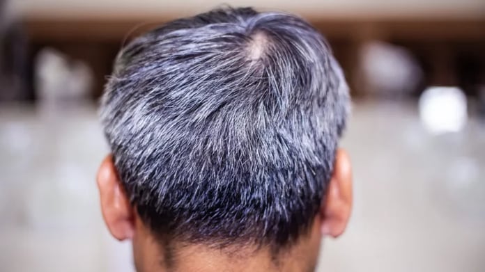  American scientists have discovered the cause of the appearance of gray hair.  It can help restore hair color


